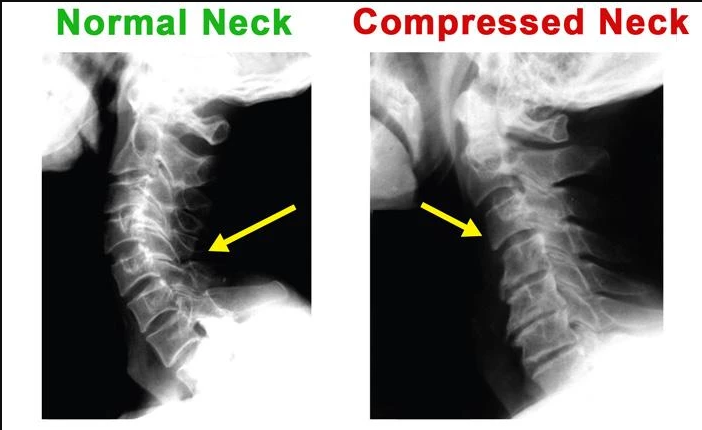 50% off today!BrighterUpTM Neck Corrector (Adjustable Height)